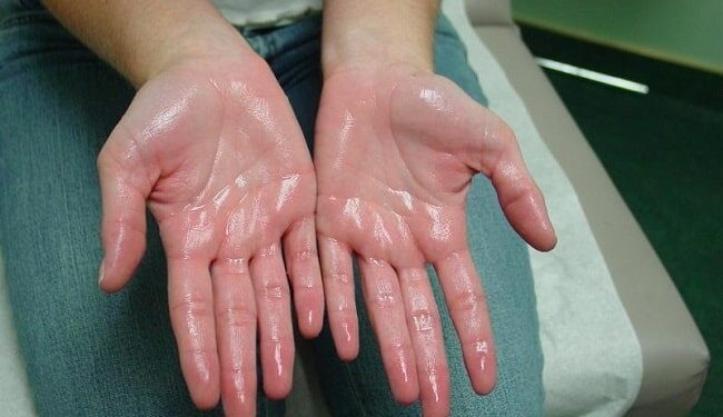 Hiperhidrosis salah satu kondisi medis yang mengganggu aktivitas