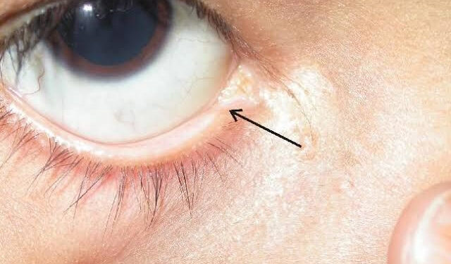 Fungsi lacrimal punctum yang sangat penting