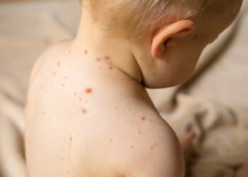 Penyakit campak masih mengancam (newsmedical)