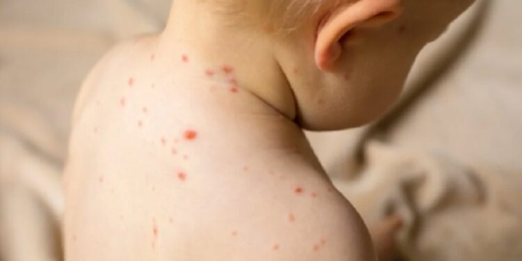 Penyakit campak masih mengancam (newsmedical)