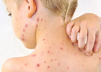 Dinkes DKI Jakarta Konfirmasi 7 Kasus Cacar Monyet