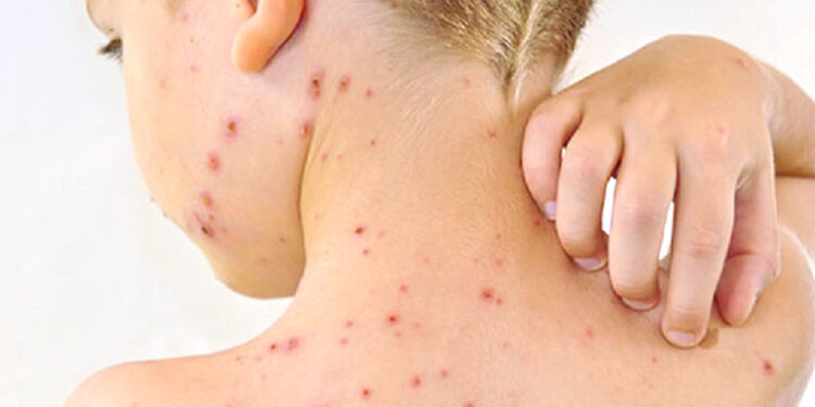 Dinkes DKI Jakarta Konfirmasi 7 Kasus Cacar Monyet