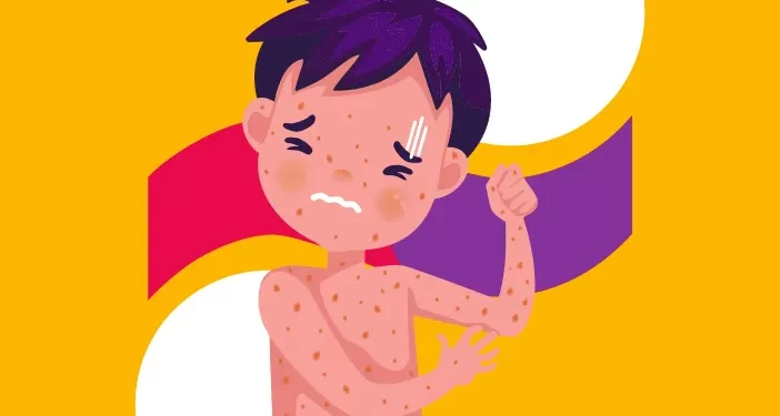 Simak, Cara Pasien Cacar Air Diperbolehkan Mandi